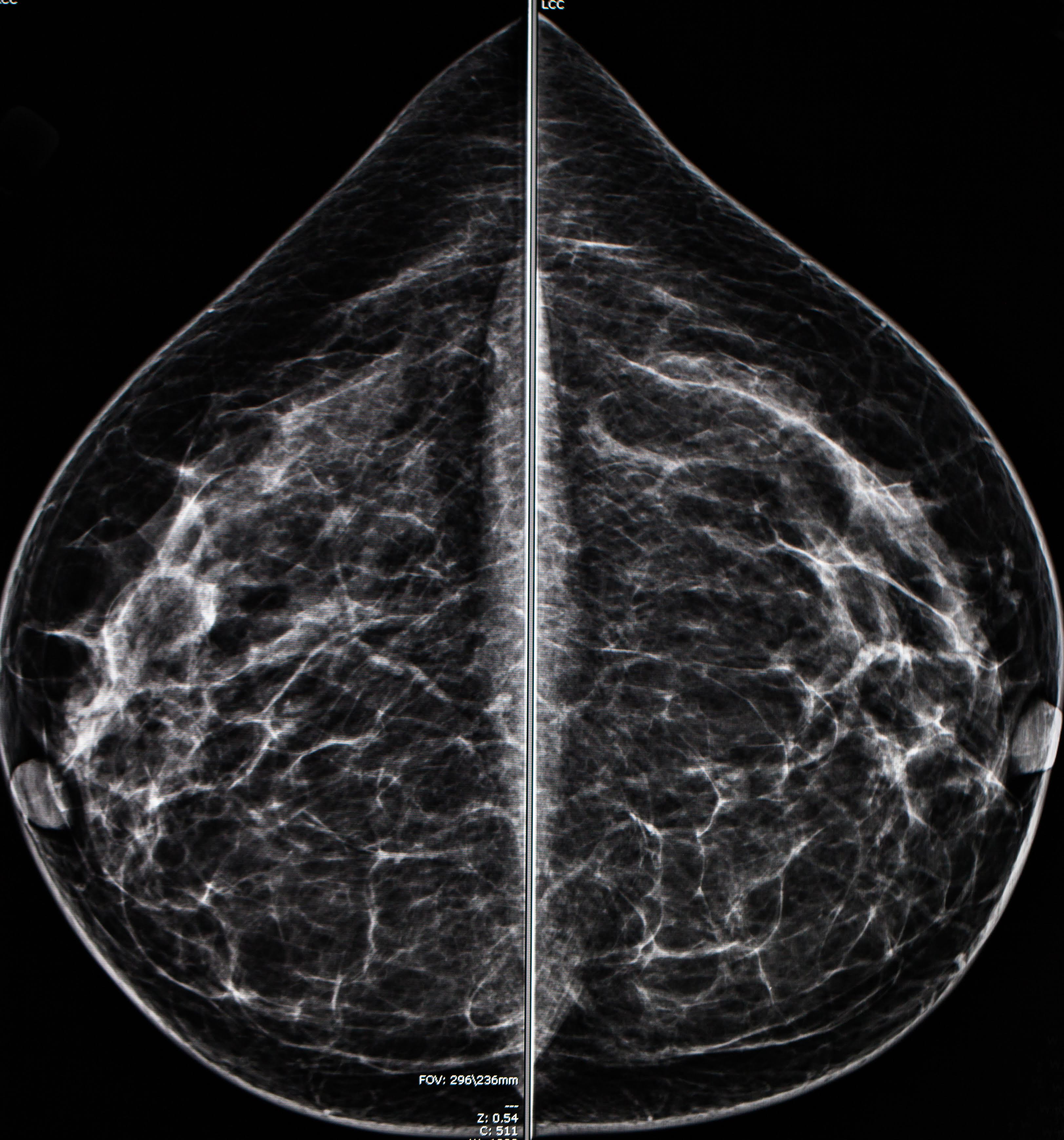 Breast Cancer Diagnosis After Missed Mammogram: Learning From Tina Knowles' Experience Breast Cancer Diagnosis After Missed Mammogram: Learning From Tina Knowles' Experience